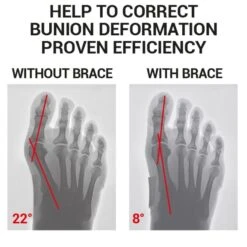 Epitact Flexible Bunion Corrector -Sports Protective Gear epitact flexible bunion corrector3